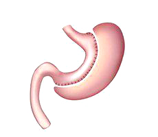 Gastic Sleeve - Gastrectomy